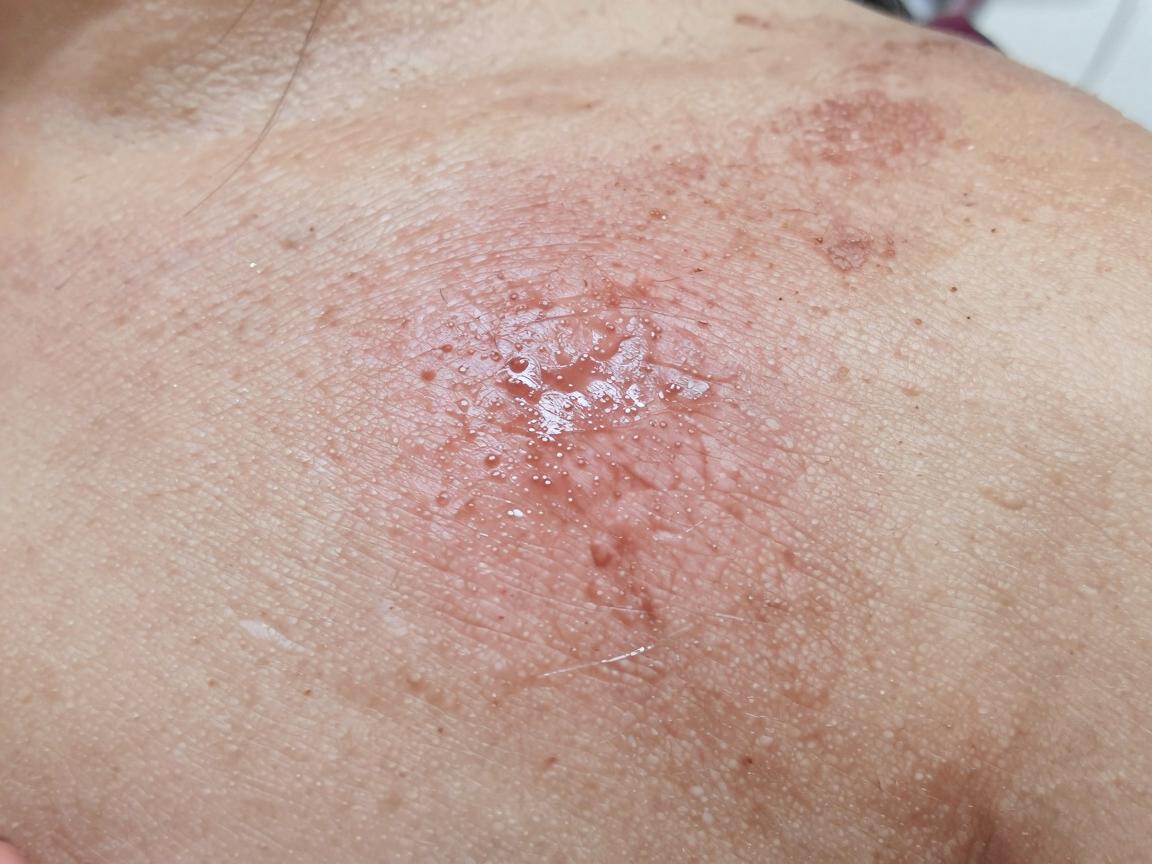 狐臭治得好吗？治得好，但别踩坑！狐臭治疗先弄清这几点